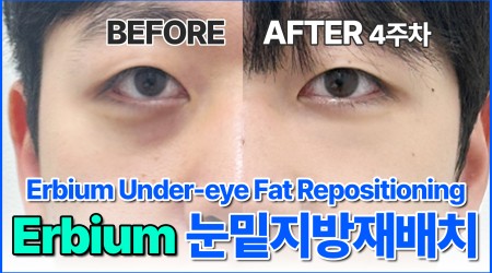 눈밑지방재배치, 수술 일주일 만에 붓…