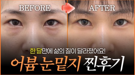 어븀 눈밑지방재배치 한달만에 컨실러 …